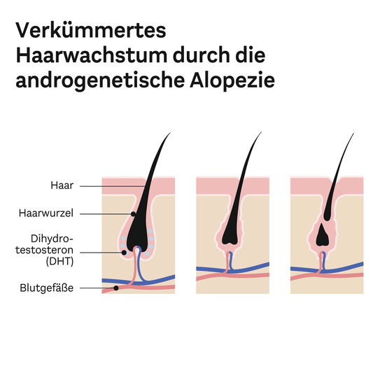 Verkümmertes Haarwachstum durch die androgenetische Alopezie