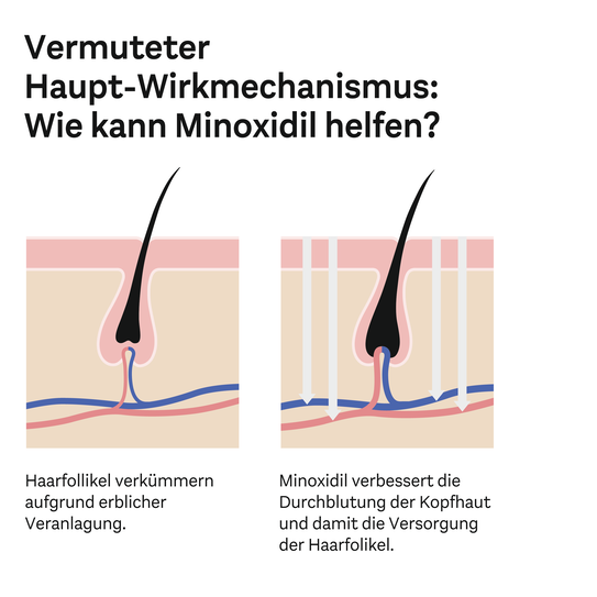 Minoxidil verbessert die Durchblutung der Kopfhaut und damit die Versorgung der Haarfolikel